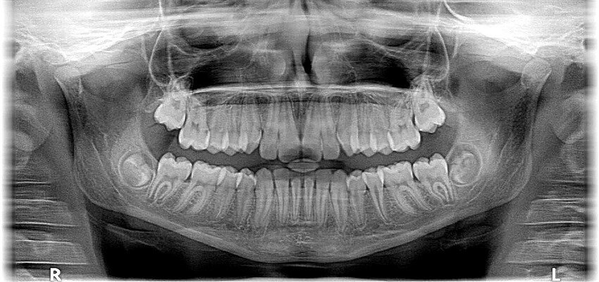 Dental X-Ray