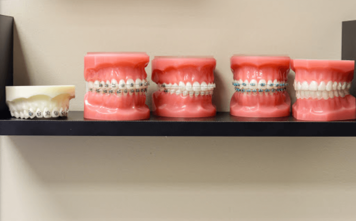 Braces Placing