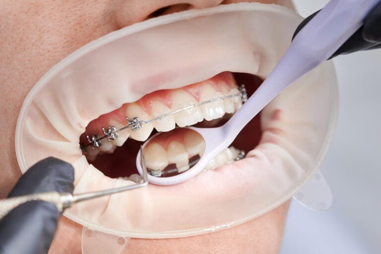 before getting braces