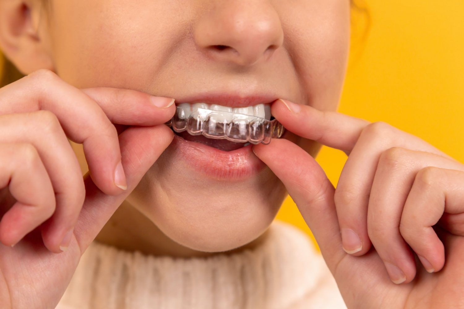 Invisalign in Richmond