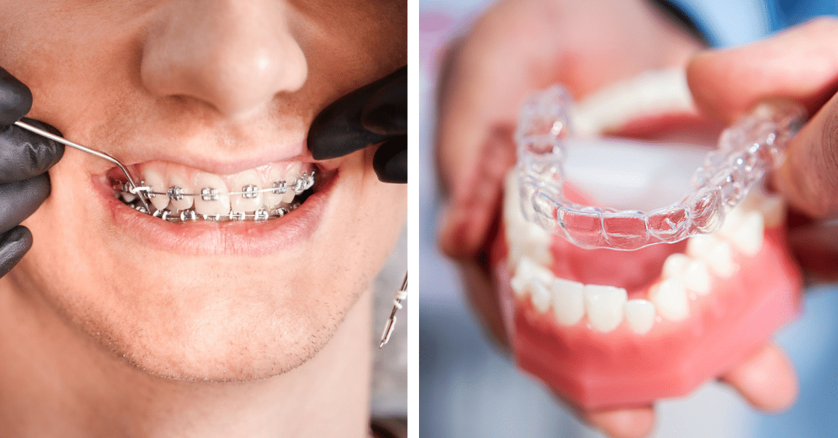 Invisalign vs. Braces Treatments: How Are They Different?