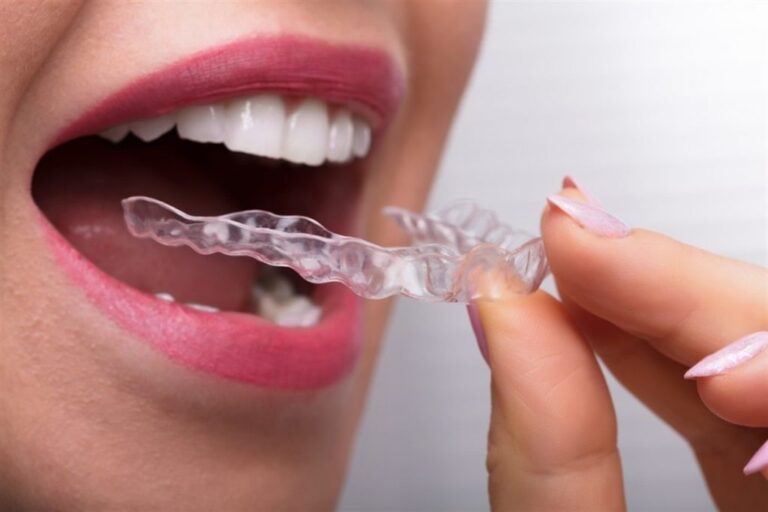 Invisalign braces